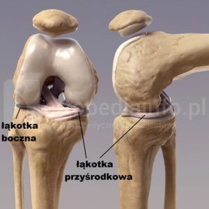 uszkodzenie łąkotki