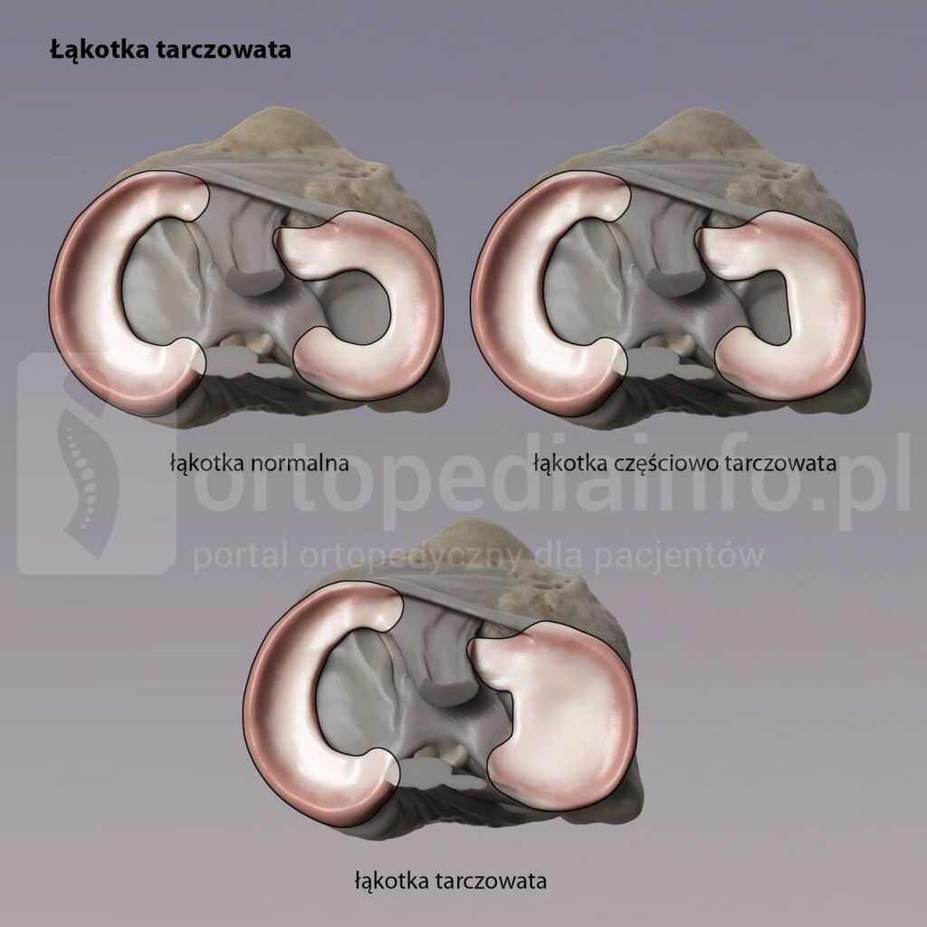 łąkotka tarczowata